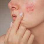 Banish Breakouts: Expert Tips to Clear Acne for Good